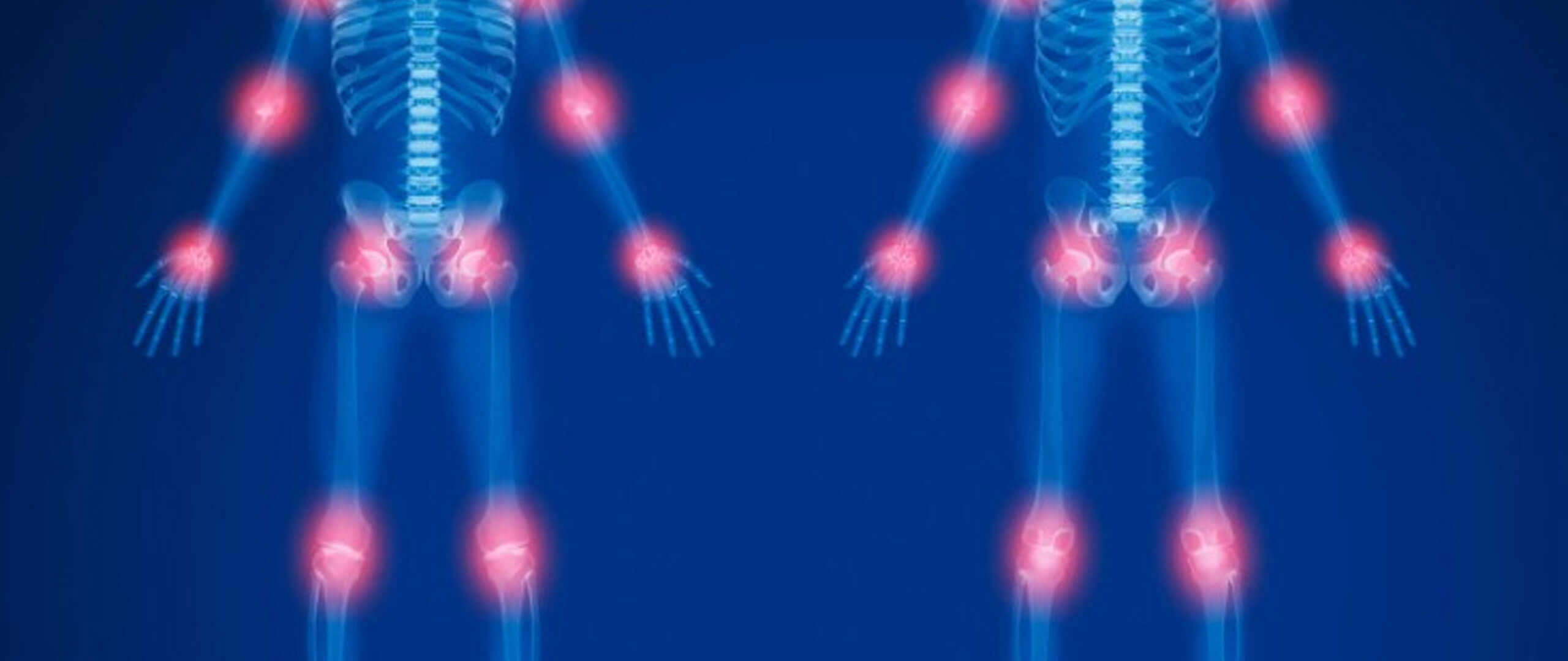 Mesenchymal stem cells as a treatment for the regeneration of degenerative articular diseases.